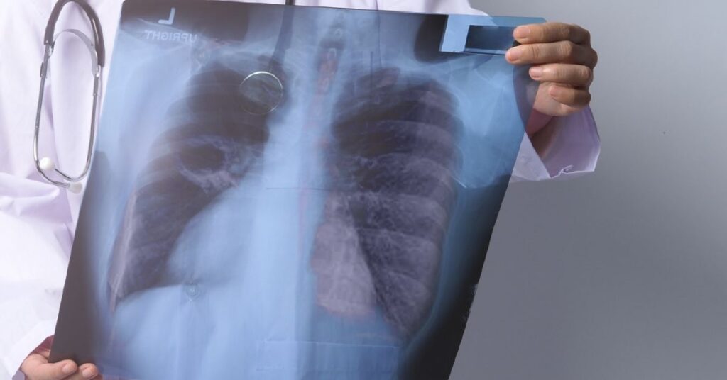 tuberculose Maranhão